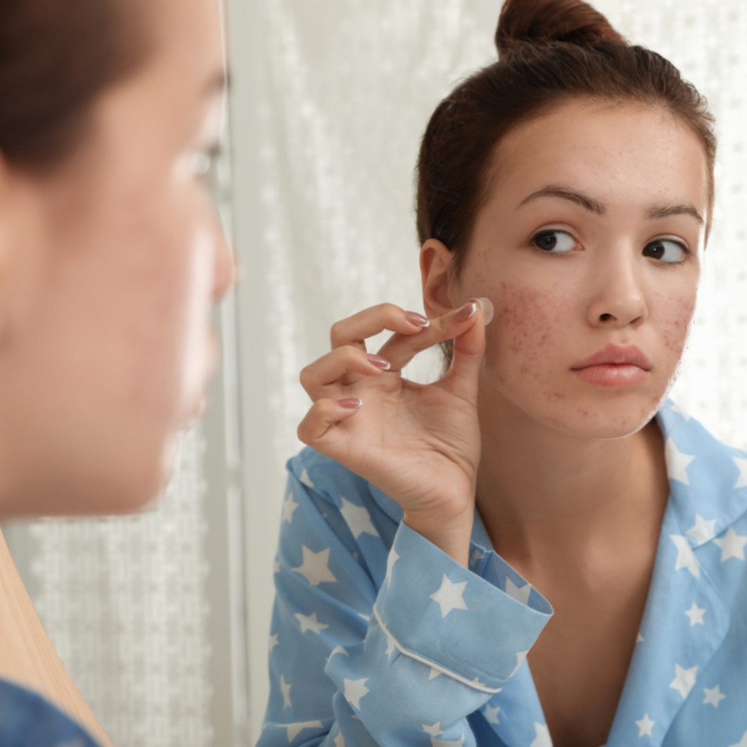 Ultimativna skincare rutina za tinejdžersku kožu sklonu aknama