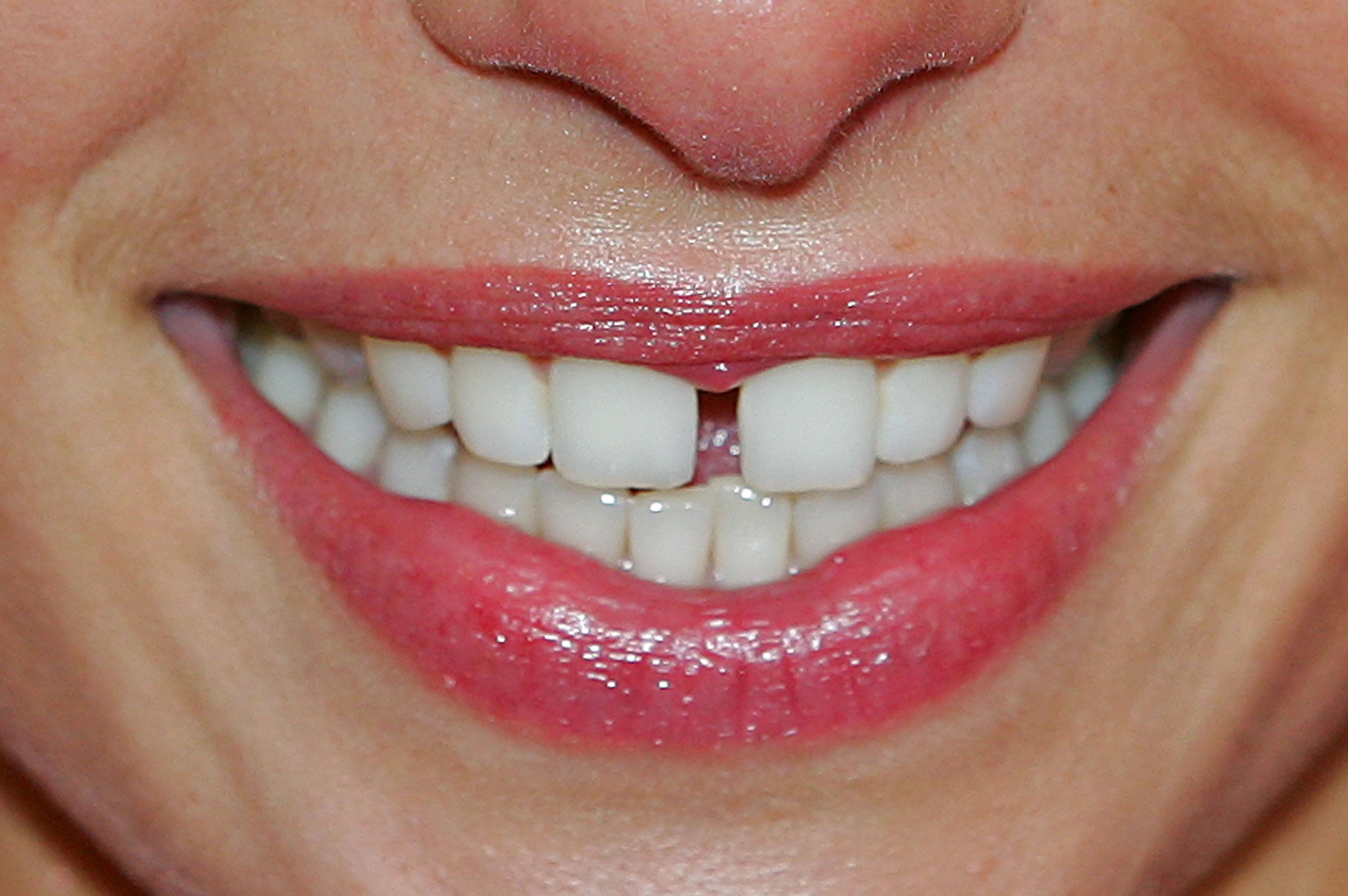 Stop preosjetljivosti zubiju