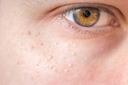 Znate li što su milije, sitne bijele 'kvržice' koje se pojavljuju na licu? Može ih uzrokovati i - hidratantna krema!