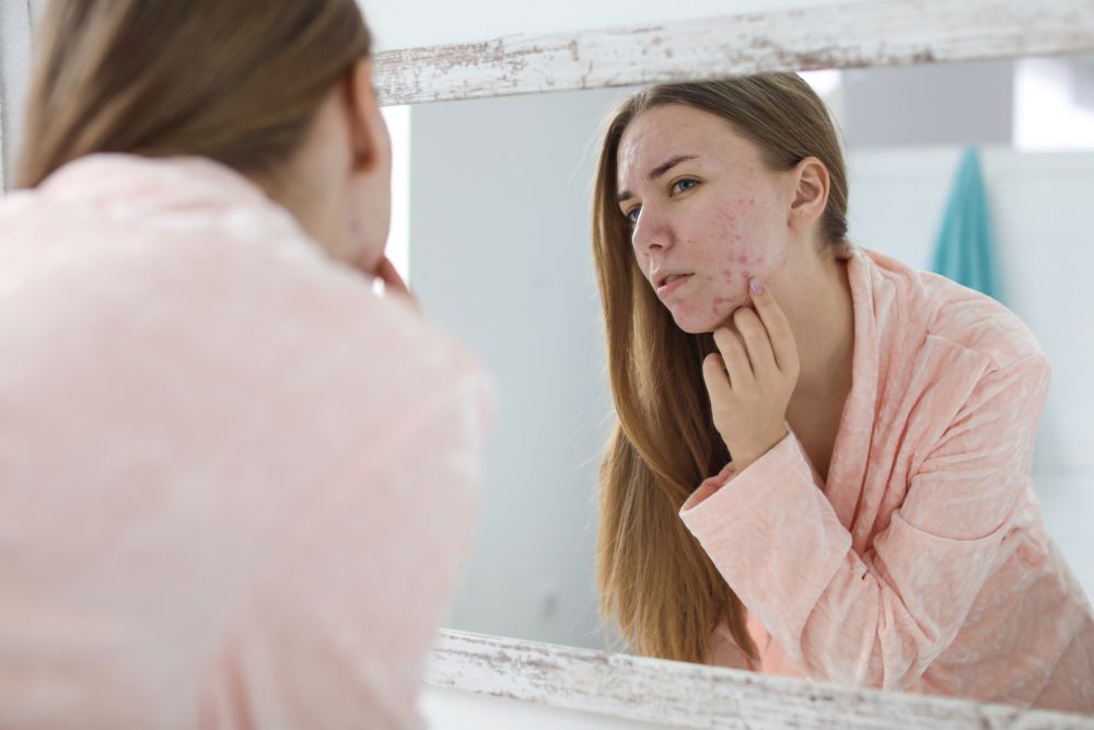 Zašto se javljaju akne u odrasloj dobi? Specijalistica dermatologije Ivana Manola navodi moguće uzroke