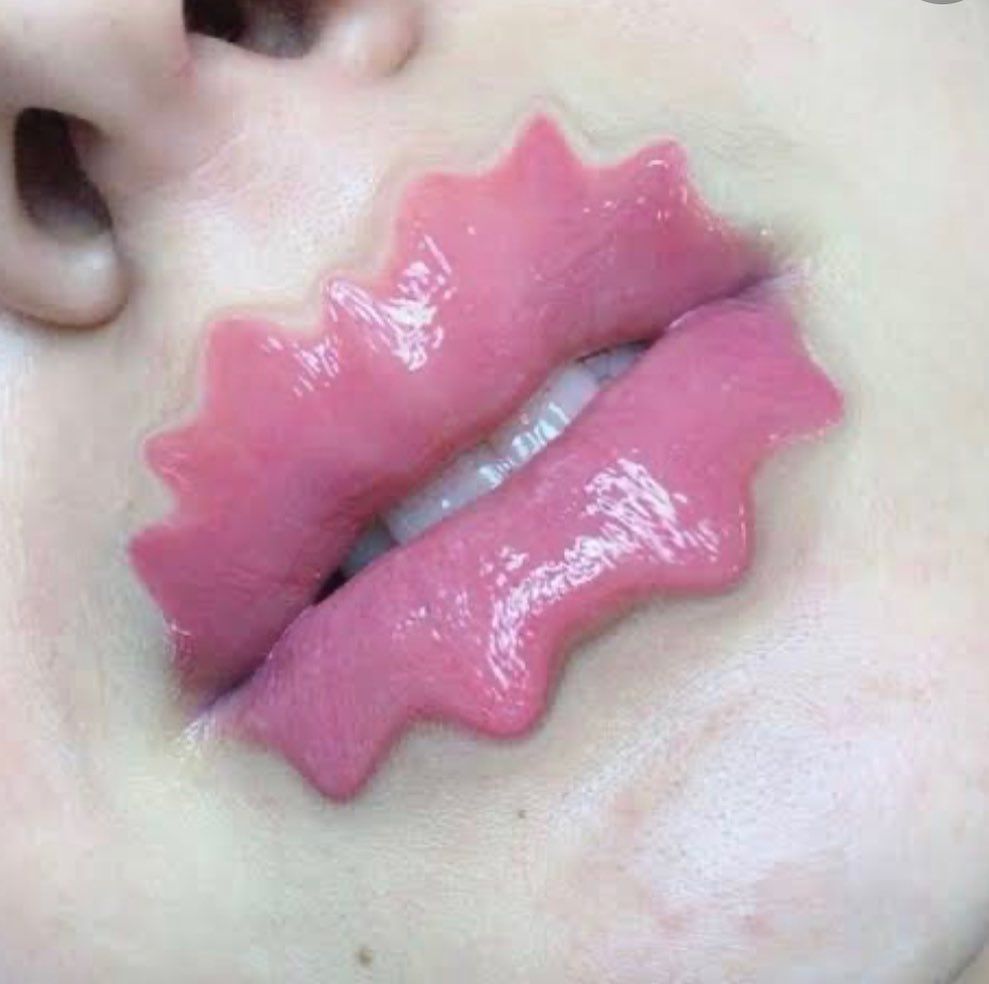 'Vražje usne' novi su bizarni trend u svijetu ljepote i estetske kirurgije 