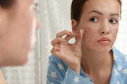 Ultimativna skincare rutina za tinejdžersku kožu sklonu aknama