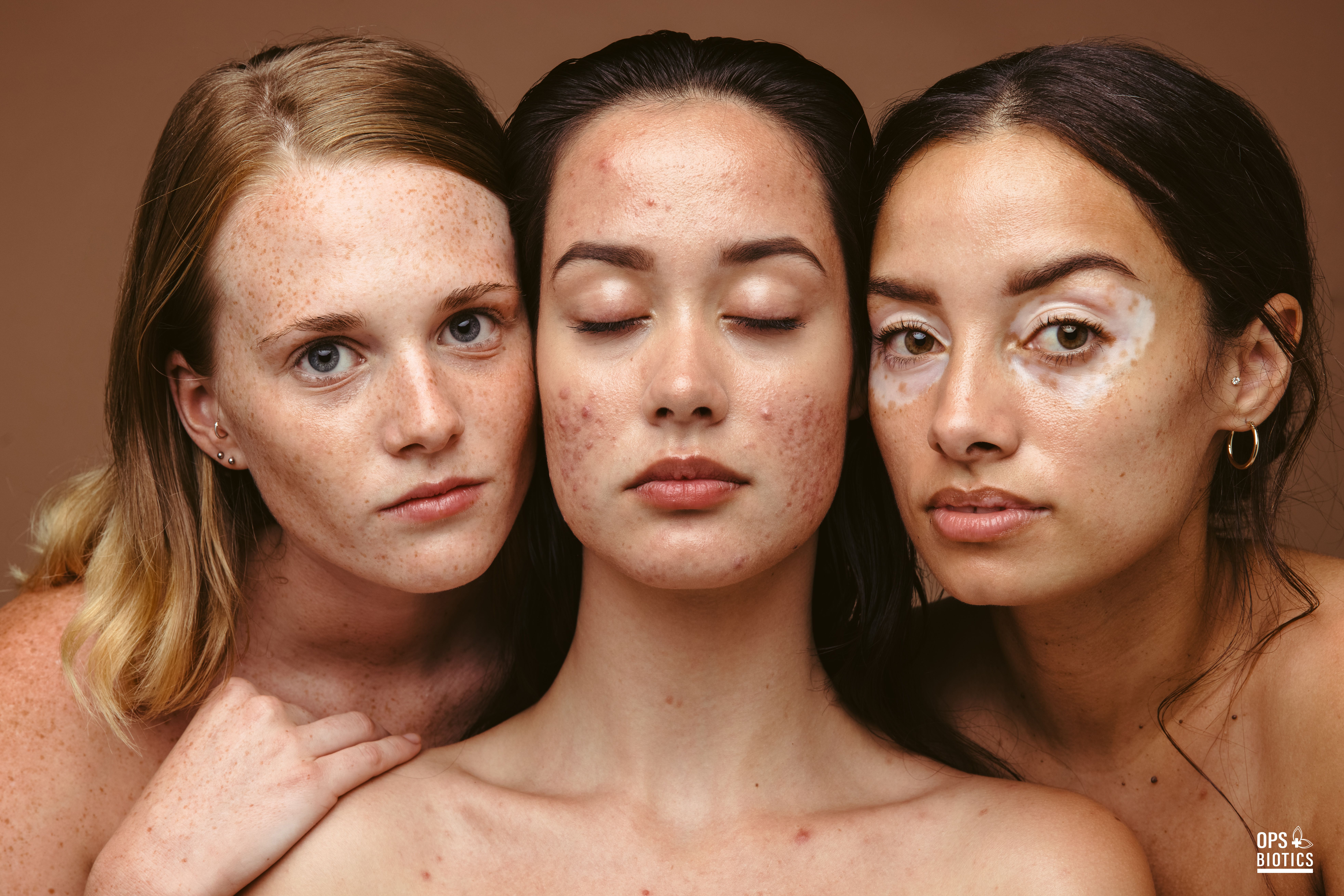 Zdrava kožna barijera: zašto je u njoj tajna zdrave i lijepe kože?