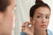 Ultimativna skincare rutina za tinejdžersku kožu sklonu aknama